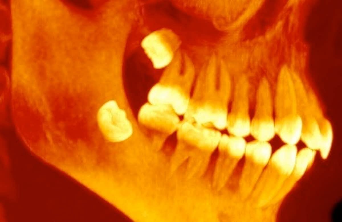 Chennai doctors extract 526 teeth from 7-year-old’s mouth