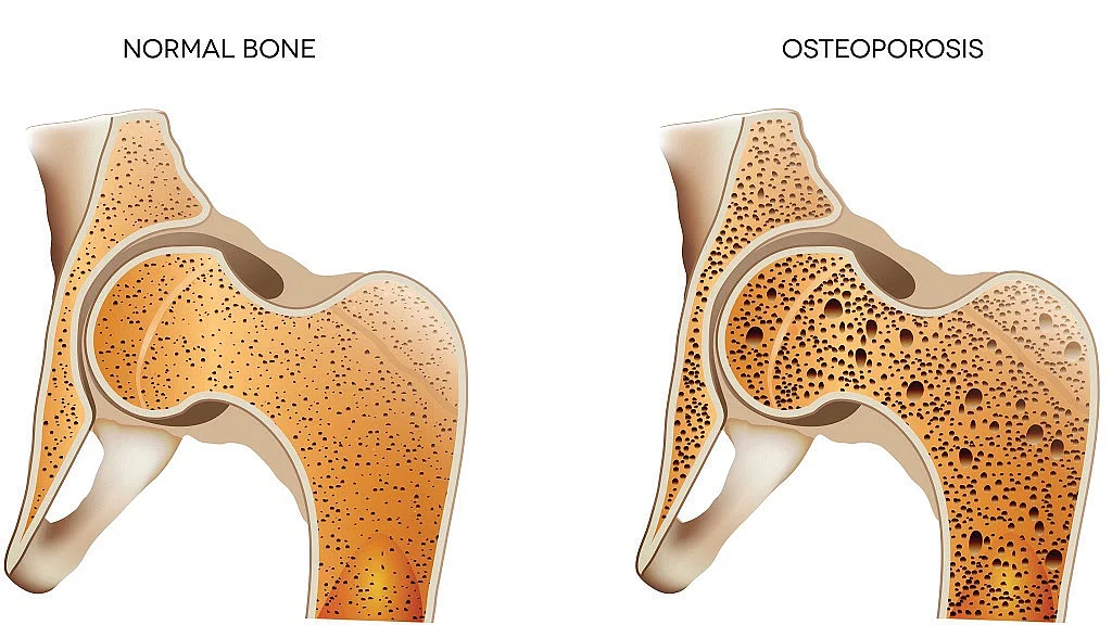 Doctor’s blog: Diagnosing Osteoporosis is a fashionable trend, a medical fad