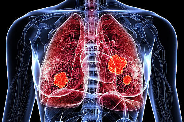 Lung cancer rates are rising in young women