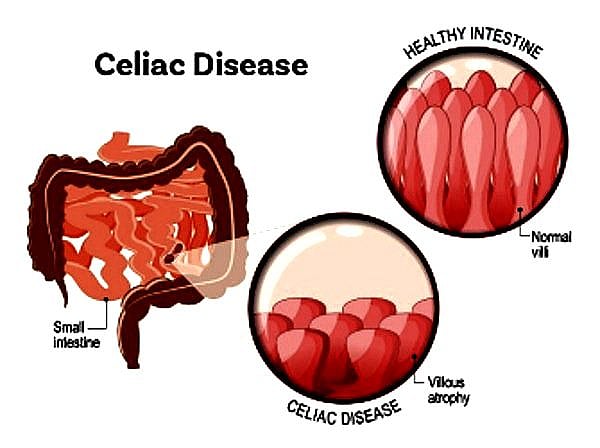 Celiac disease linked to increased risk of premature death
