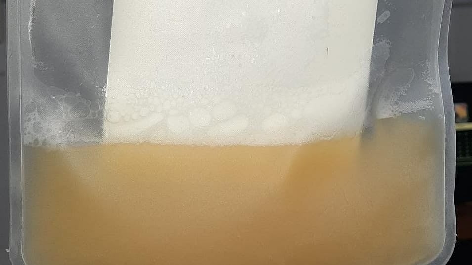 Covid survivor donating plasma and a picture of the plasma extracted from his blood