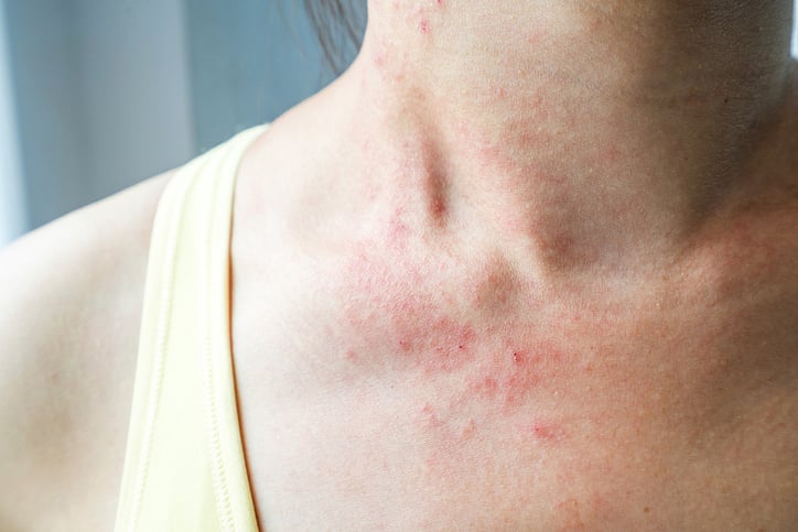 How to control an eczema flare up in summer