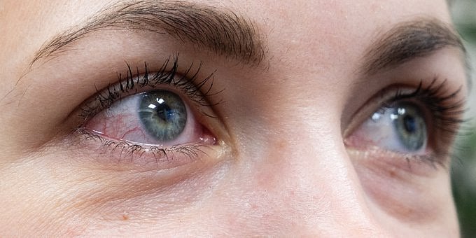 Amid conjunctivitis surge, doctors warn against irrational use of steroid eye drops