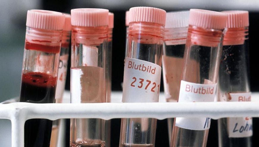 Blood test can predict severity of COVID-19: Study  