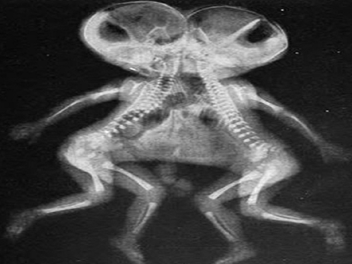 UP family seeks financial help after birth of conjoined twins