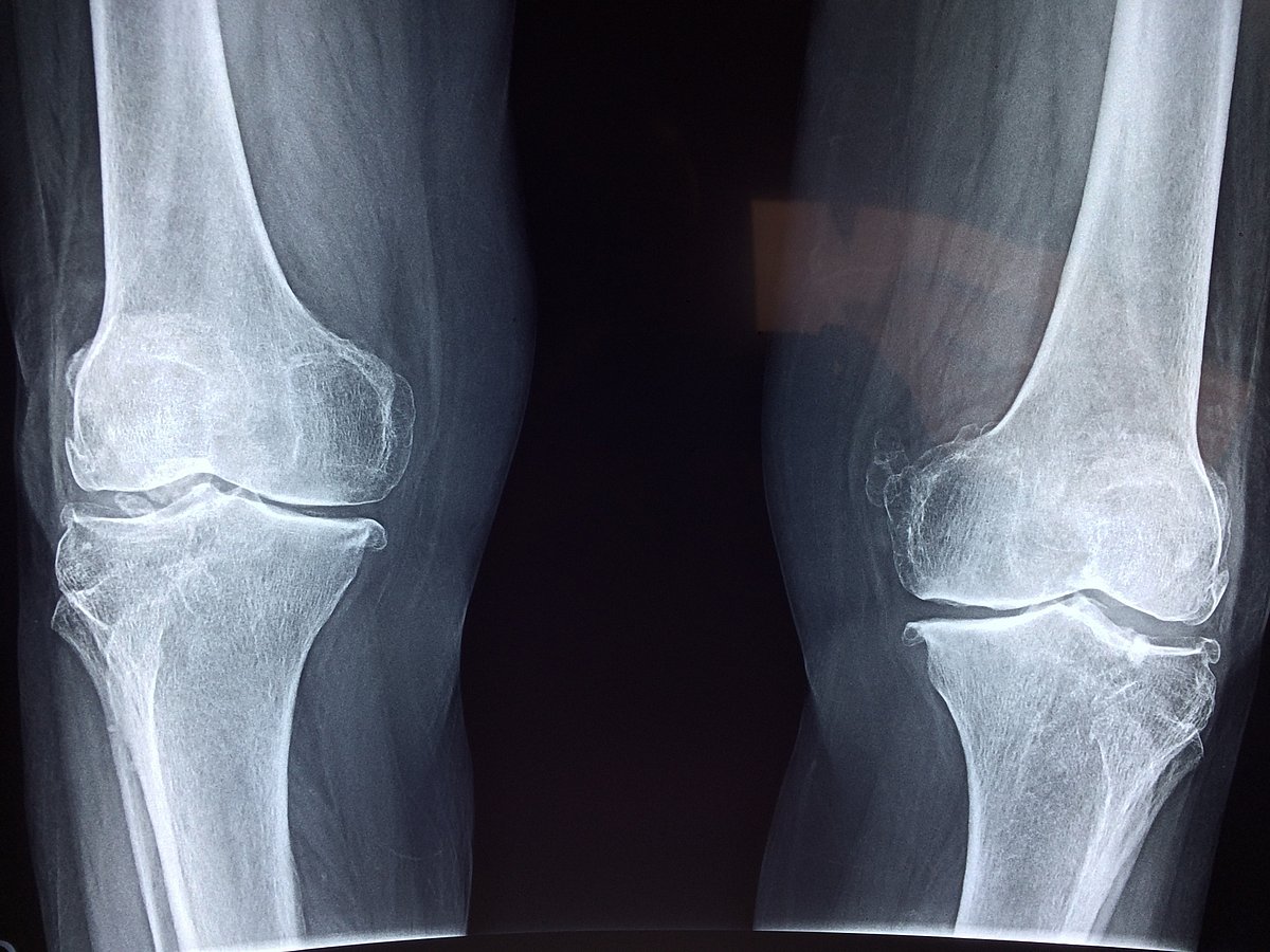This alternative surgery may prevent total knee replacement