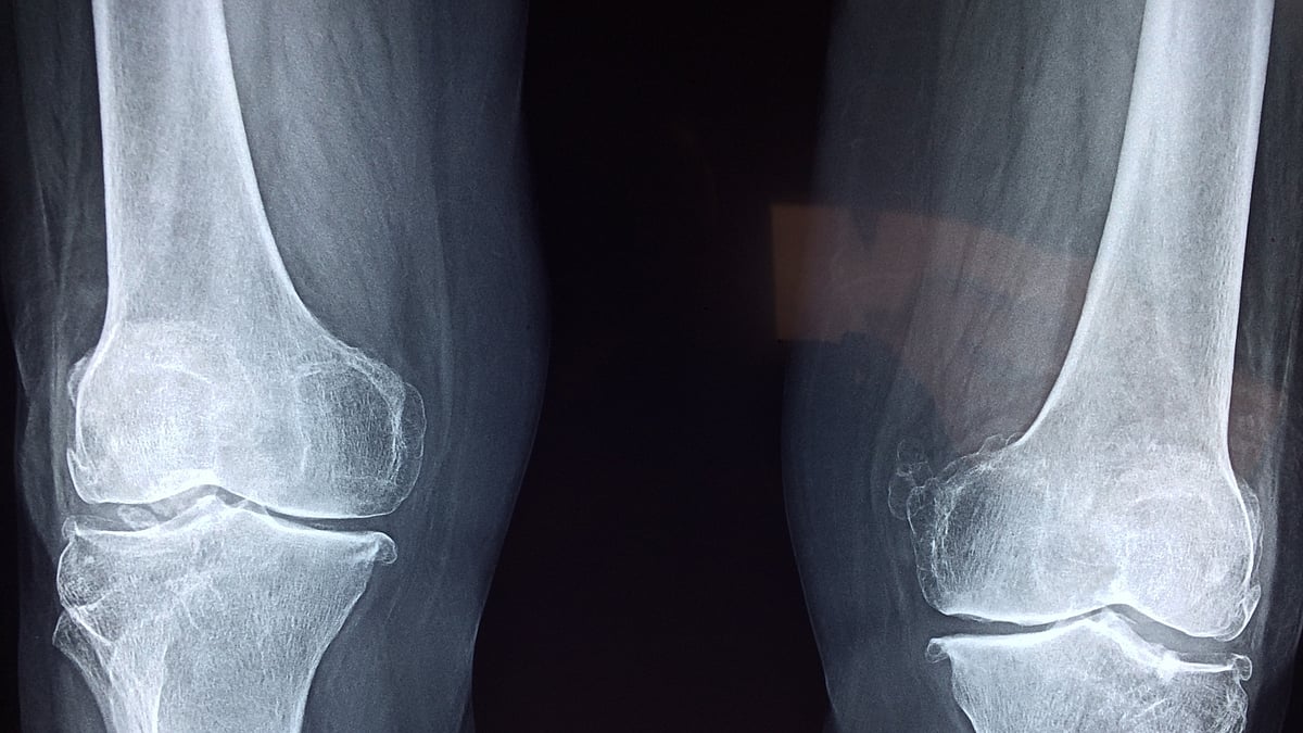 This alternative surgery may prevent total knee replacement