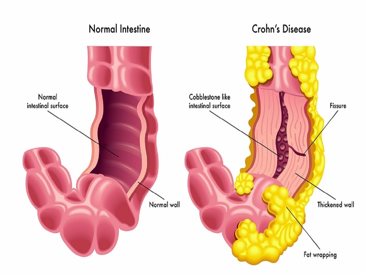 Novel potential therapy for Crohn’s disease in children