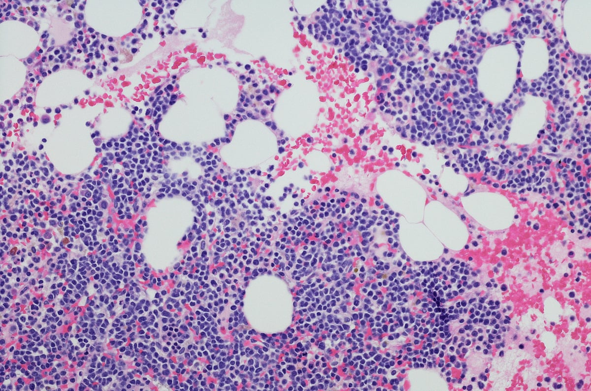 Bone marrow transplant effective for multiple myeloma patients: Experts