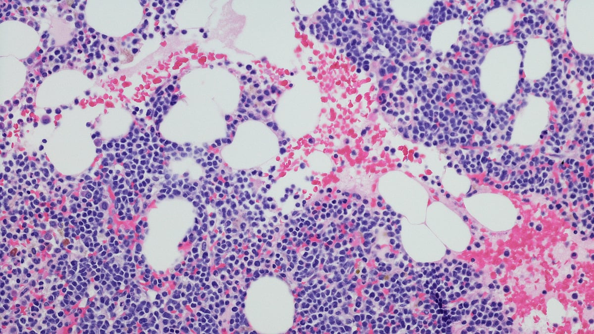 Bone marrow transplant effective for multiple myeloma patients: Experts