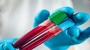 CAR T-cell therapy effective in treatment of rare cancer in children