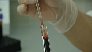 Nipah suspected in patient in Mangaluru, samples sent for test