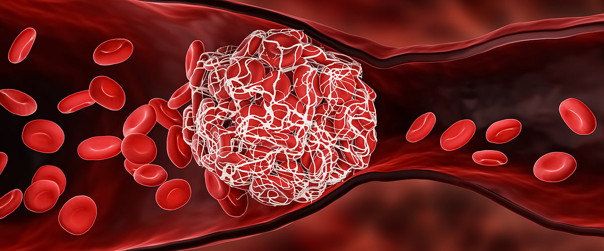 Inflammatory microscopic clots in blood may explain long Covid