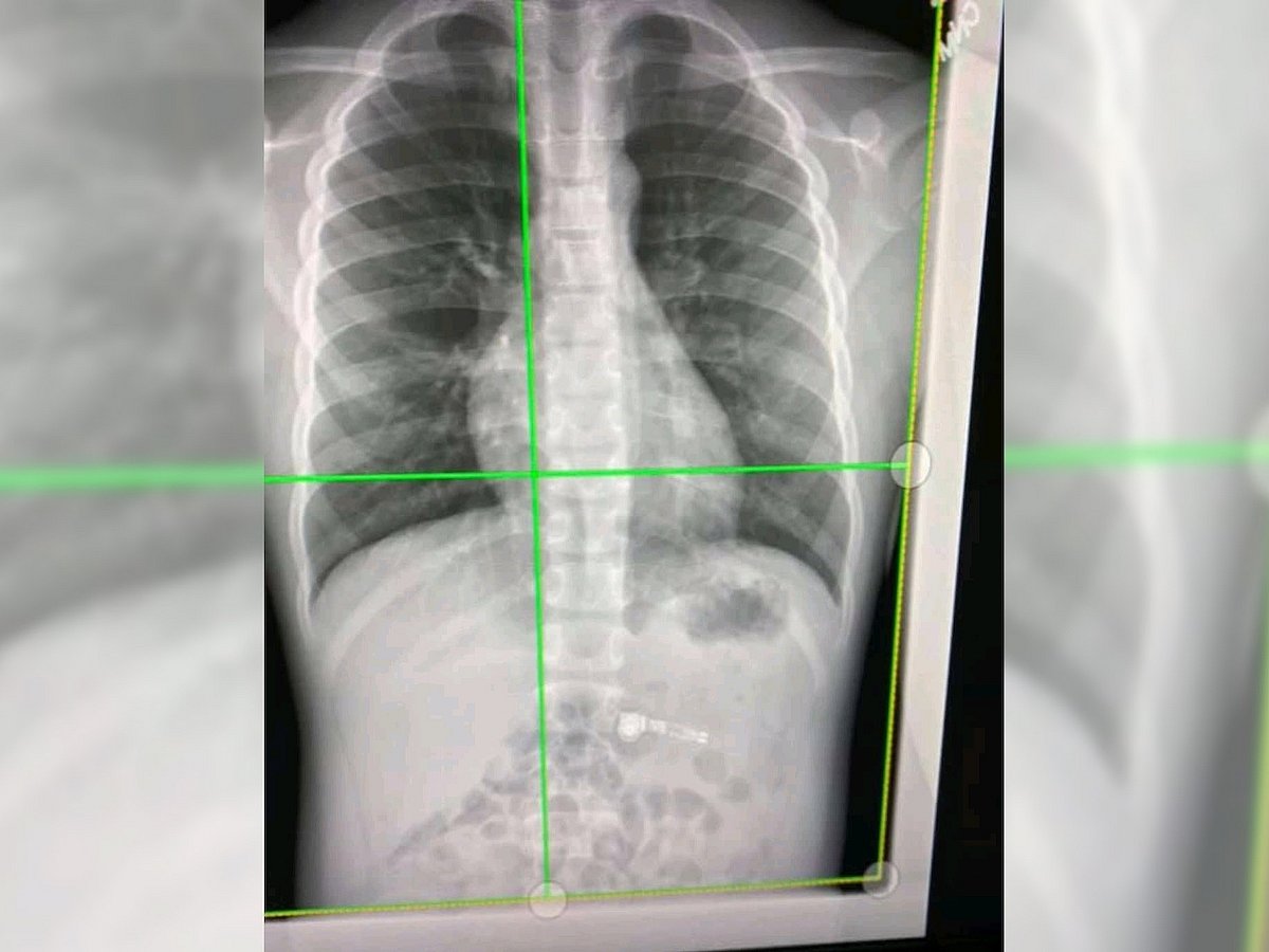 High-energy X-rays show lung vessels altered by Covid-19