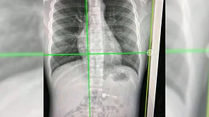 High-energy X-rays show lung vessels altered by Covid-19