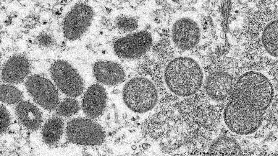 Monkeypox threat: Mumbai civic body keeps isolation ward ready in hospital