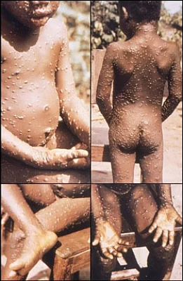 Monkeypox primarily spread via sexual contact, but containable: WHO