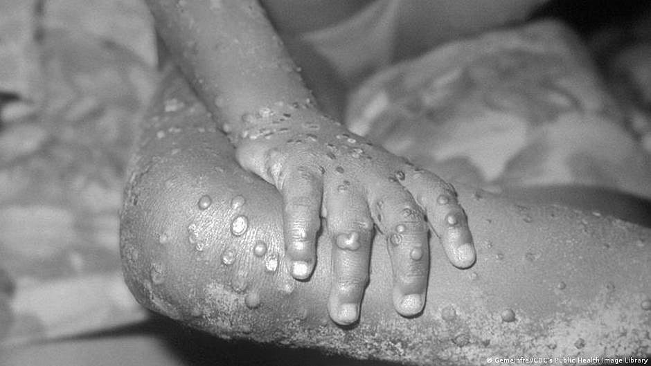 Antiviral drugs may reduce monkeypox symptoms, shorten contagious phase: Lancet study