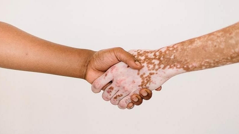 Signs to detect Vitiligo