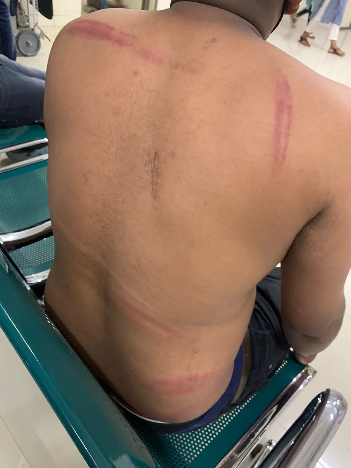 Binshad has fractured his shoulder