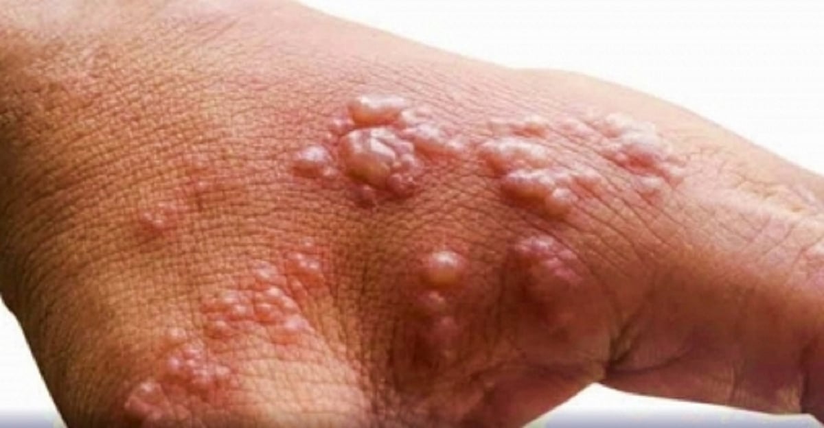 Task force to be set up to provide guidance to govt on tackling monkeypox