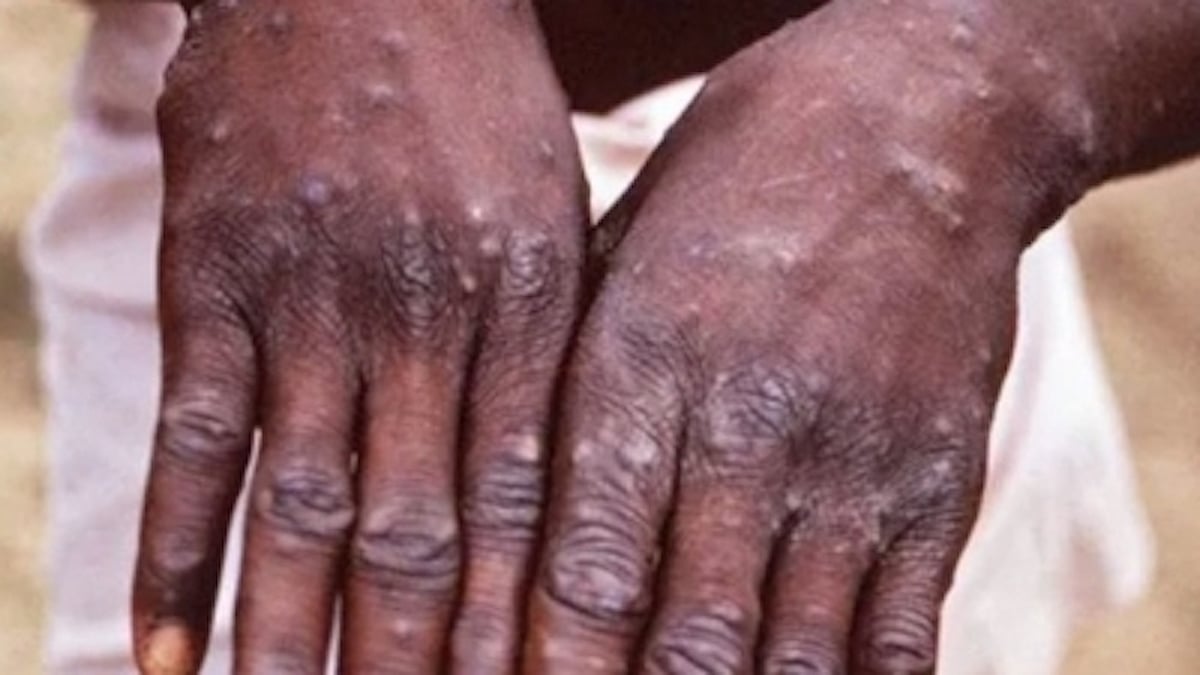 Monkeypox: Should we be scared of it? A look at the symptoms and guidelines to be aware of