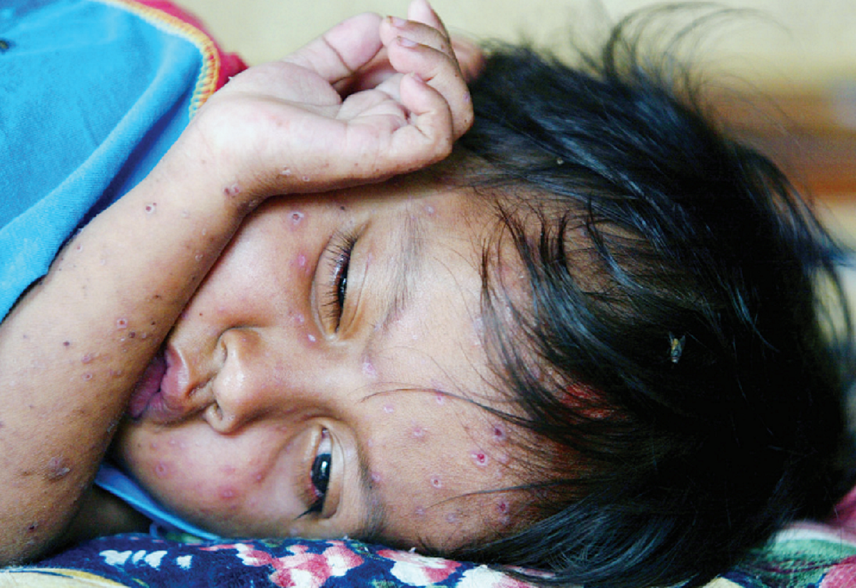 Monkeypox: Surveillance needed of high risk groups, not the entire population