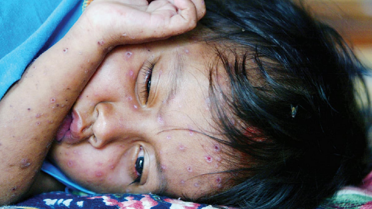 Monkeypox: Surveillance needed of high risk groups, not the entire population