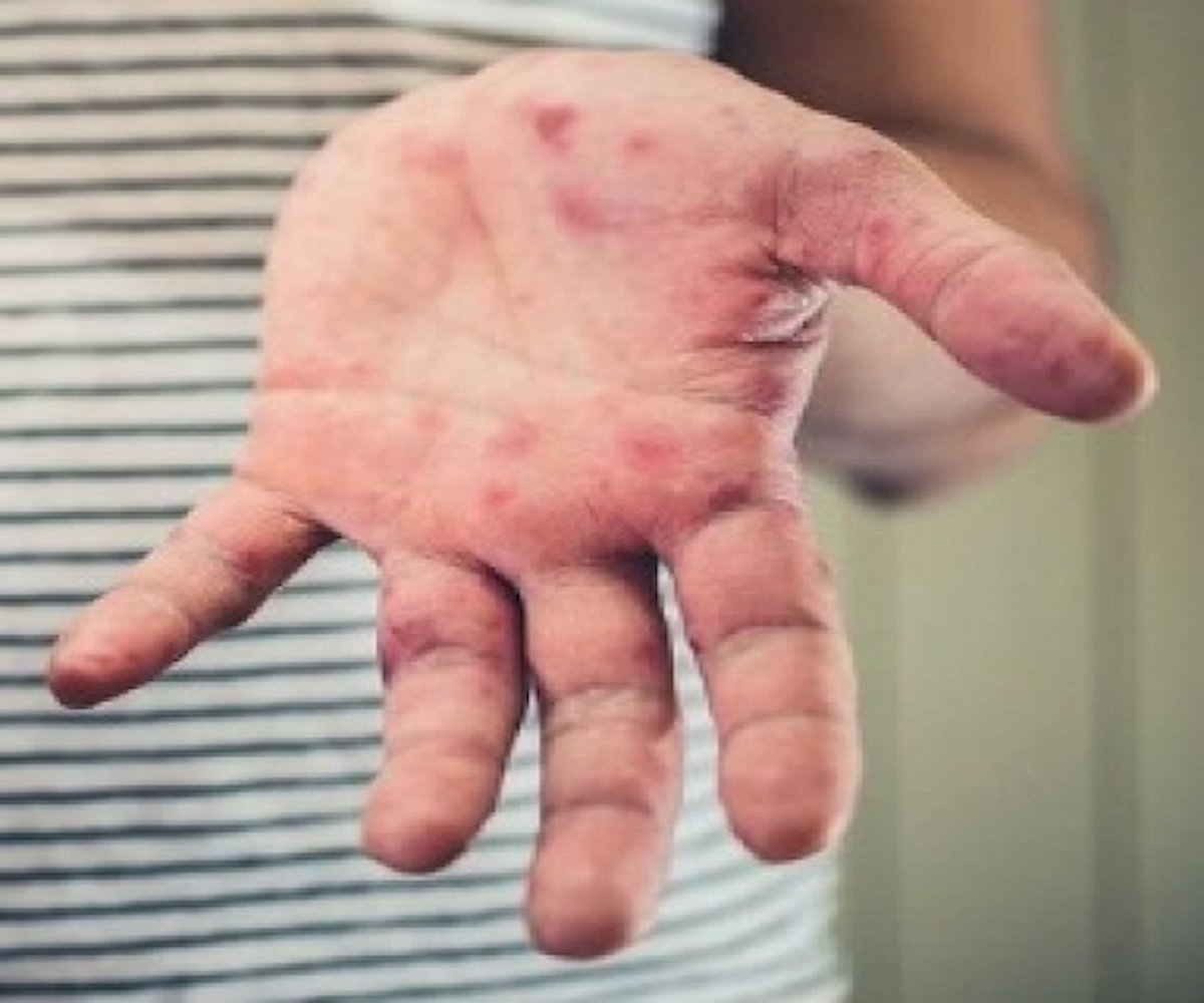 What is tomato flu: All you need to know