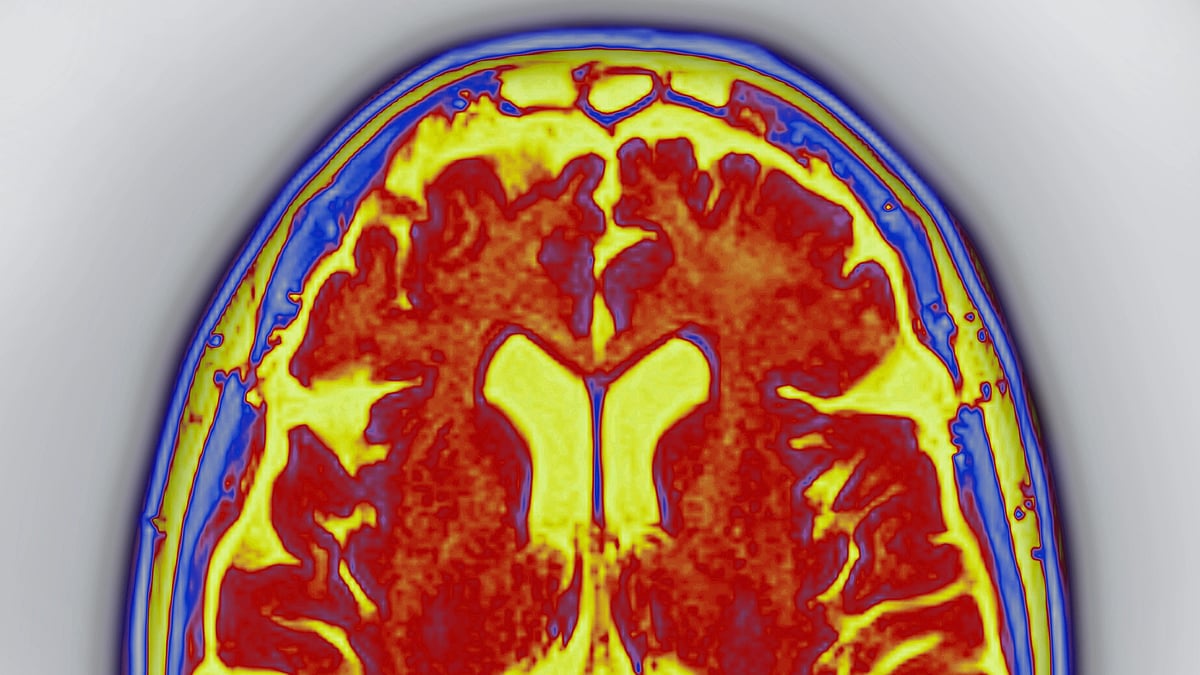 Common heart rhythm disorder more likely to cause dementia in women than men