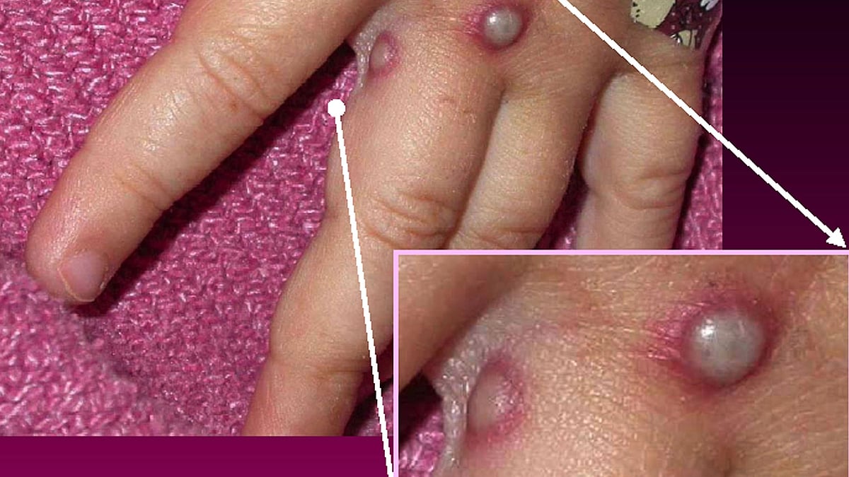 Smallpox spreads in Bihar village, locals allege medical negligence