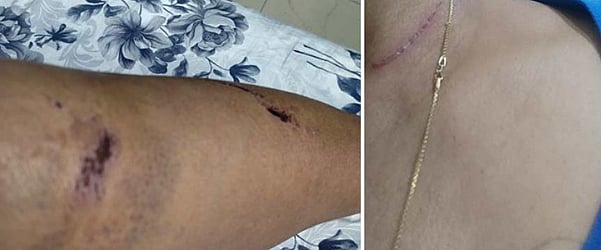62 year-old Sheila's* injuries (photo courtesy Sudeshna Banerjee)