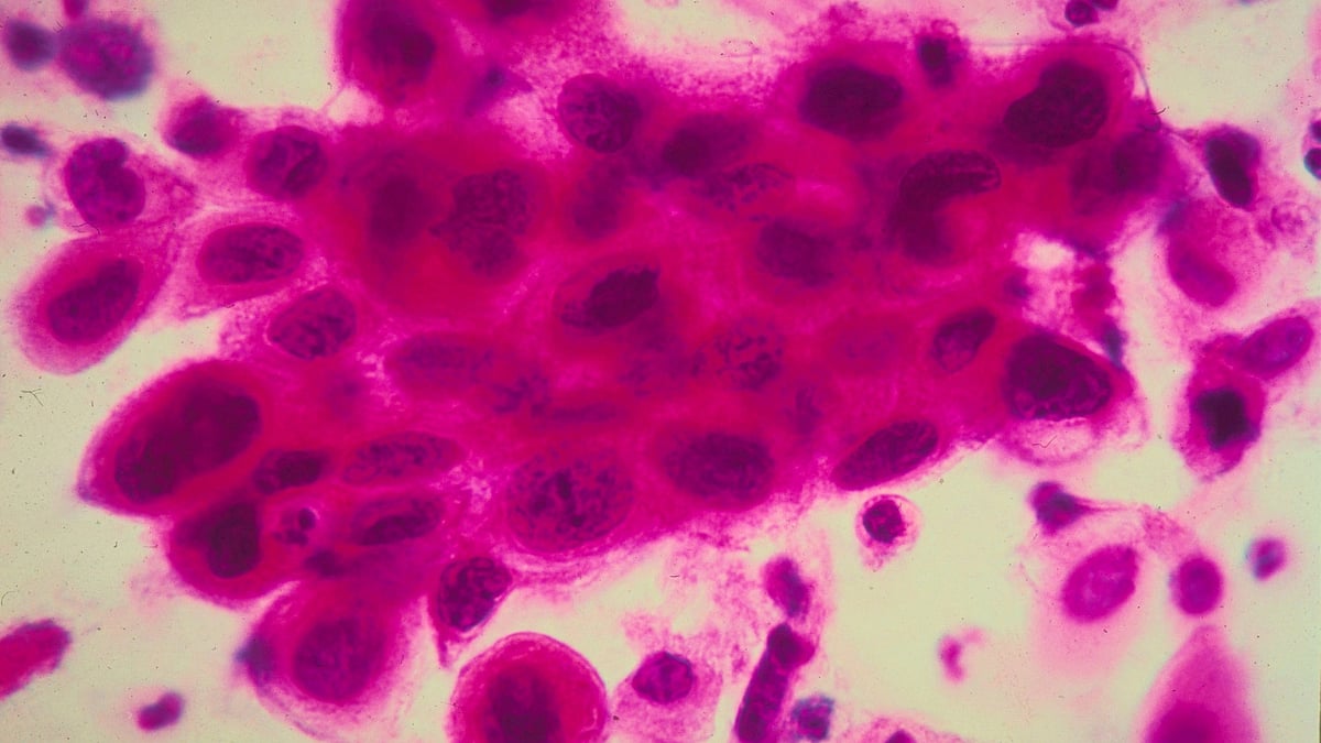 Alarming health trends: 79% increase in under-50s cancer cases