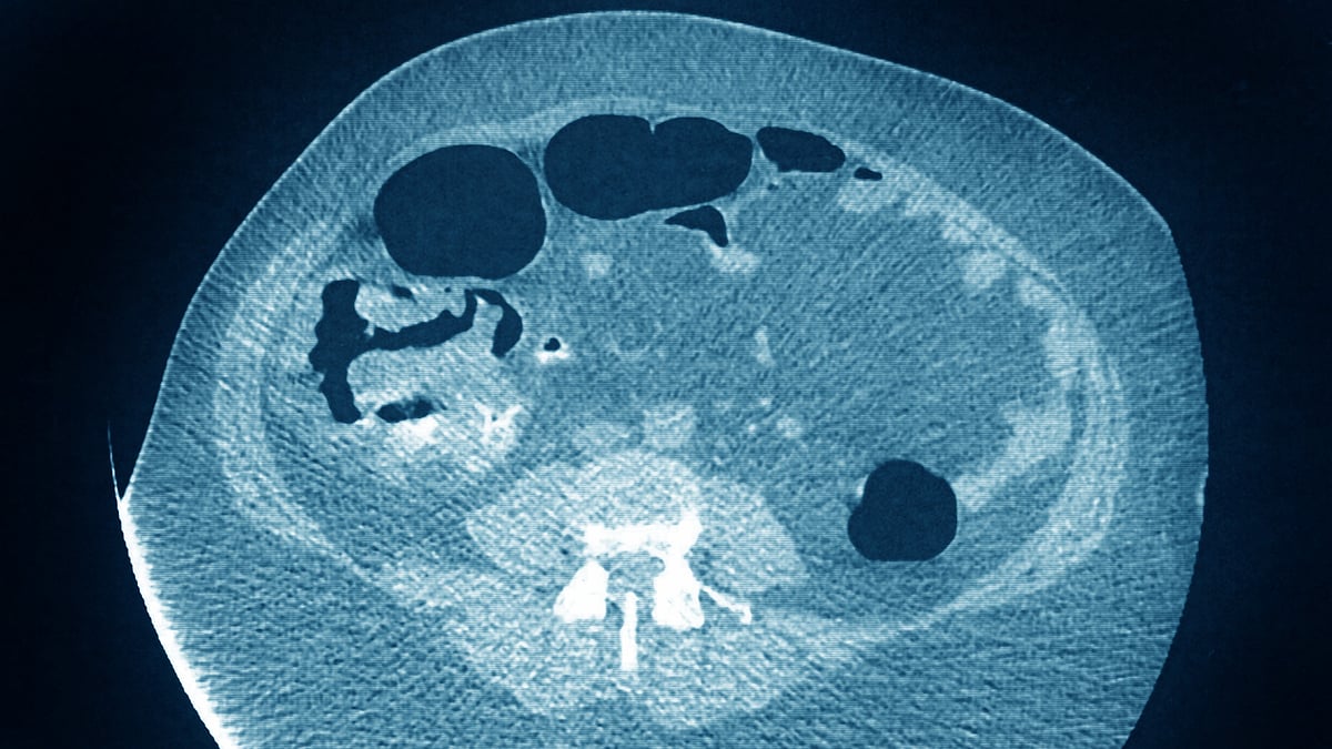 Scientists find new genetic risks for colon cancer 