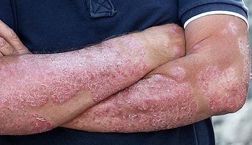 Representative image of psoriasis (photo: IANS)