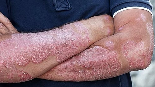 Representative image of psoriasis (photo: IANS)