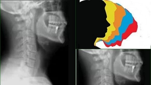 Representative image. "Text-neck syndrome" is characterised by strained and stiff neck muscles (photo: IANS)