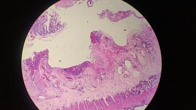 Global fungal disease deaths doubled in a decade: Study