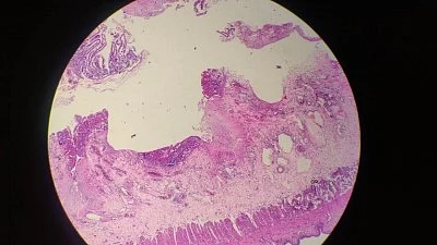 Around 1.2 million deaths (32 per cent) had other underlying disease, with fungal disease contributing (photo: IANS)