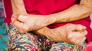The disfigurement of leprosy makes social stigma hard to avoid (representative image: IANS)