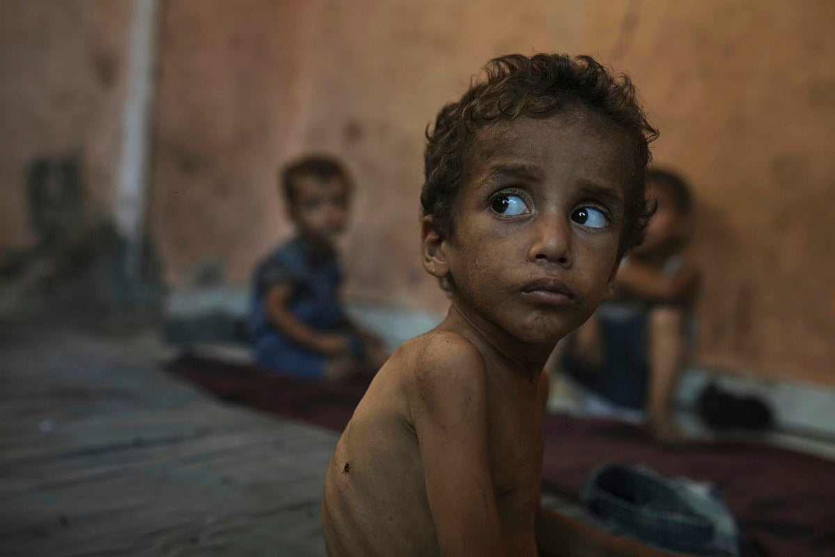 Yazan Abu Ful, age 2, malnourished, at Shati refugee camp, Gaza City, 23 July 2025