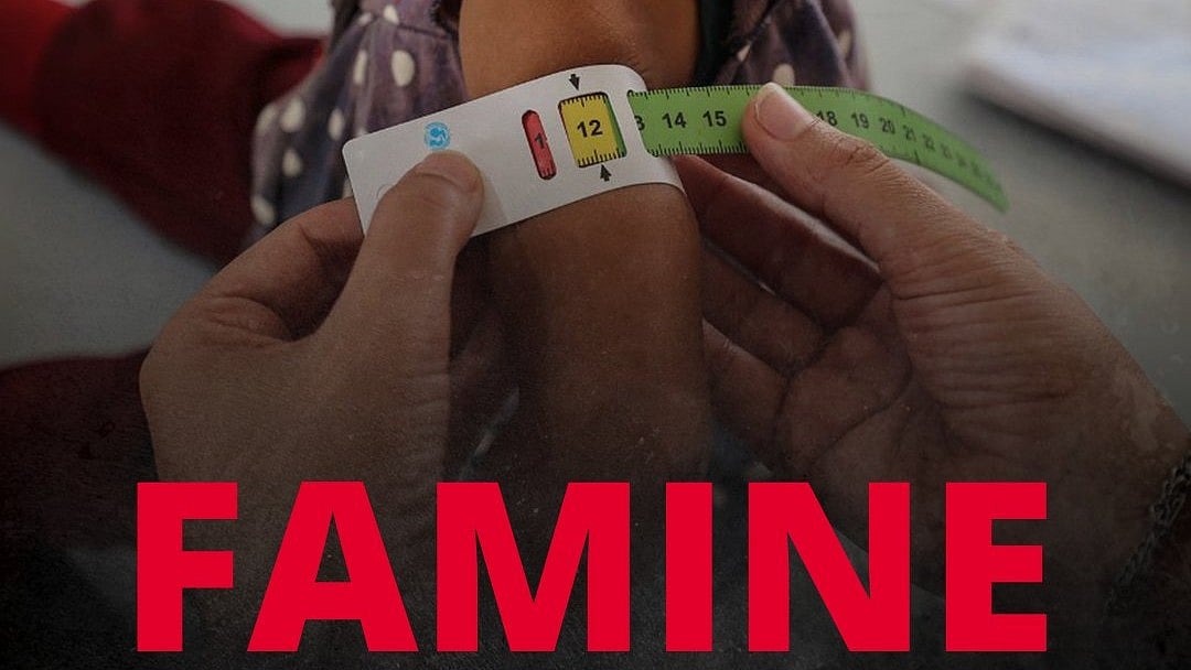 ‘Skin stretched over protruding bones’: Doctors bear witness to Gaza starvation