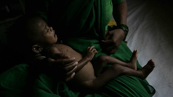 कुपोषण से पीड़ित बच्चा/ फोटो: Getty Images
