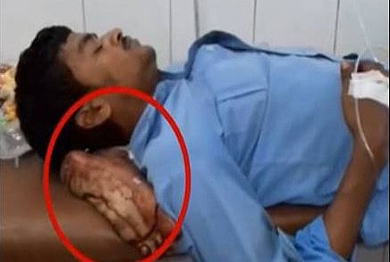 यूपी के योगी राज में सरकारी मशीनरी की दिल दहला देने वाली  लापरवाही, घायल  के कटे पैर को ही लगा दिया सिरहाने