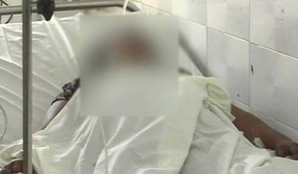 यूपी: योगी राज में नहीं बदले हालात, अब मुजफ्फरनगर में घर में घुसकर रेप पीड़िता पर आरोपियों ने फेंका तेजाब