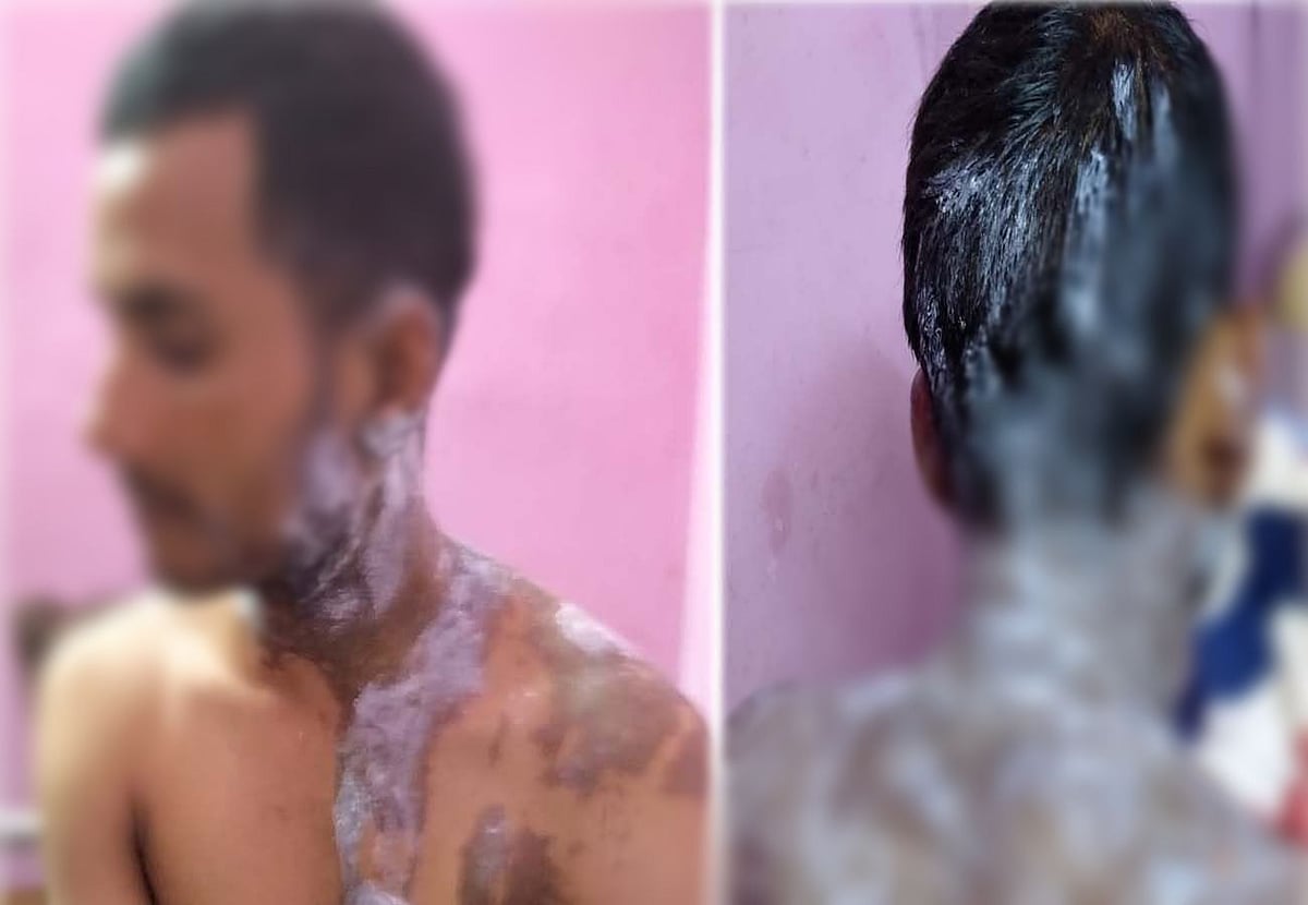 उत्तर प्रदेश: उन्नाव में एकतरफा प्यार में युवती ने लड़के पर फेंका तेजाब, गंभीर हालात में अस्पताल में  भर्ती