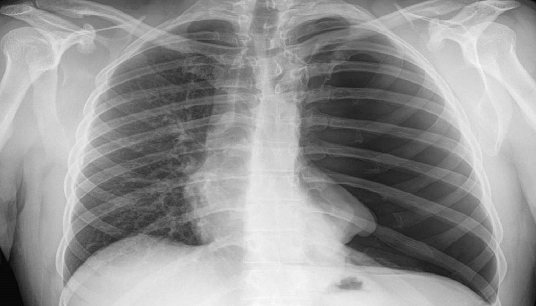 भारतीय डॉक्टरों को मिली कामयाबी, अब सीने का X-Ray बताएगा मरीज कोरोना संक्रमित है या नहीं 