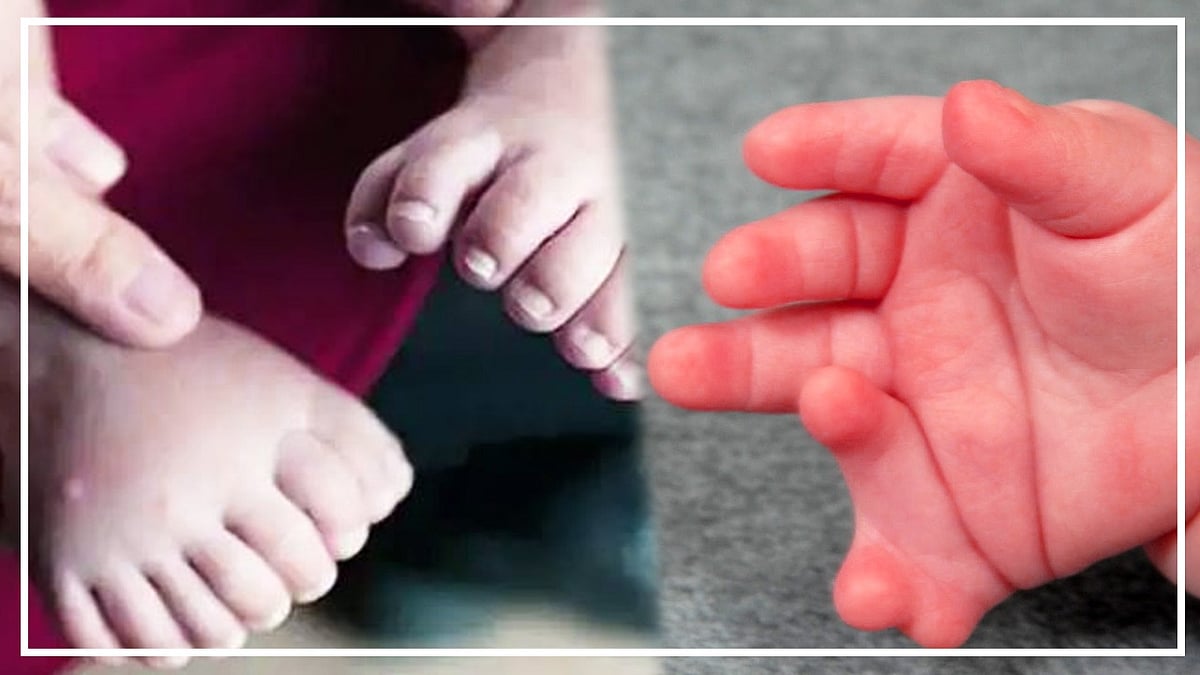 वीडियो: 33 अंगुलियों के साथ पैदा हुई बच्‍ची,  इलाज कर रहे डॉक्टरों के भी उड़े होश! 