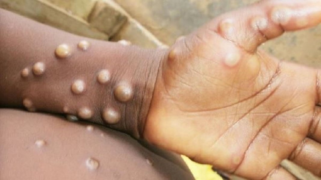 कोविड जितना खतरनाक नहीं है Mpox का वायरस, WHO ने बढ़ते खतरे के बीच किया साफ