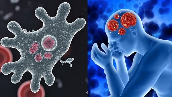 कैसे एक घातक अमीबा केरल में ले रहा है जान? 19 लोगों की हो चुकी है मौत